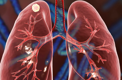 Fighting TB through Universal Health Coverage in COVID-19 era