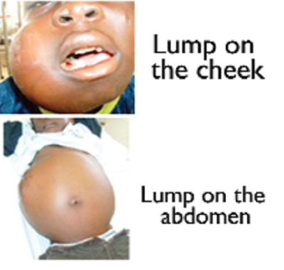 International Childhood Cancer Day: Global community pushes for better survival rate