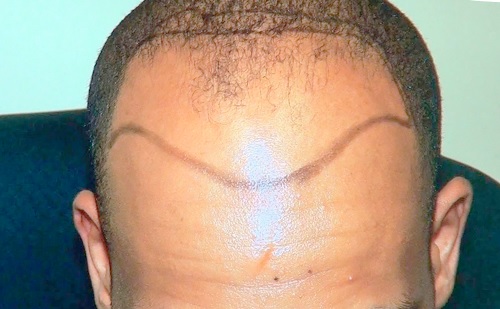 Most men attribute their receding hairline to genetics