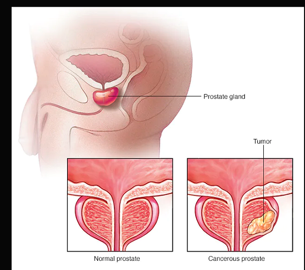 Every man has prostate!- What is wrong with yours?