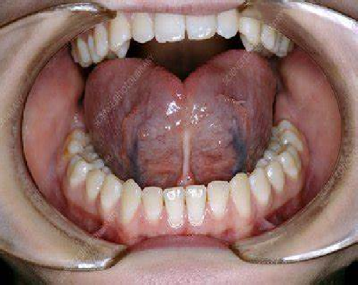 Tongue-tie