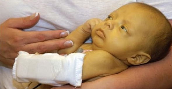 A baby with jaundice 