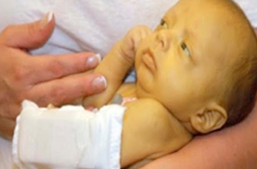 • A baby with jaundice 