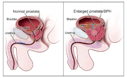 Normal prostate and benign prostatic hyperplasia (BPH).  A normal prostate does not block the flow of urine from the bladder