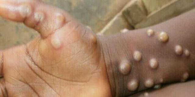 Monkeypox claims 4 lives, 116 local cases recorded