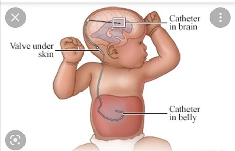 Treating babies with fluid in their heads   