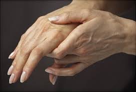 What Is Arthritis?