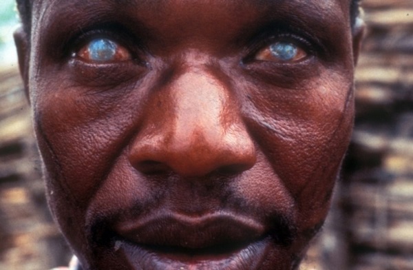Let’s pay extra attention to neglected tropical diseases: Noguchi 