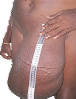 An inguinal hernia patient