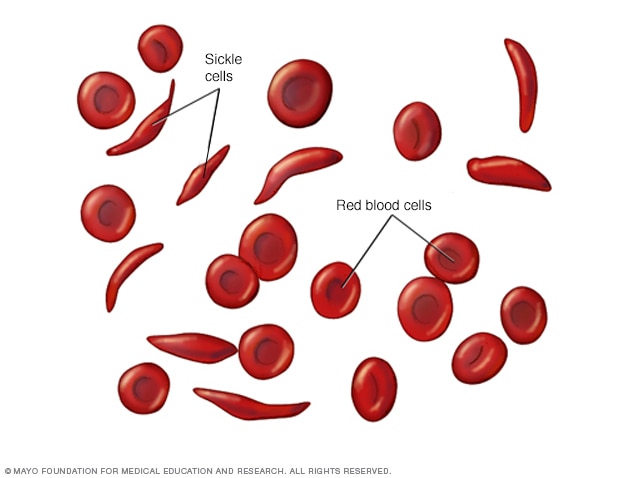 Different types of crises in sickle cell