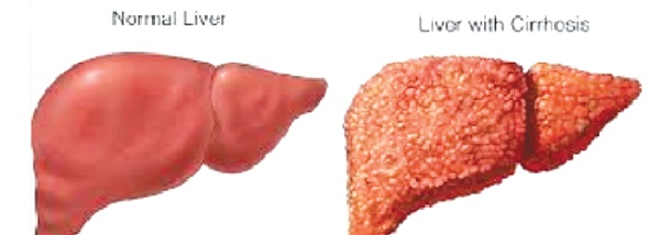 World Hepatitis Day: Awareness of disease key