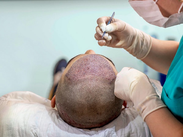 Tattoos, surgeries to the rescue  of bald men
