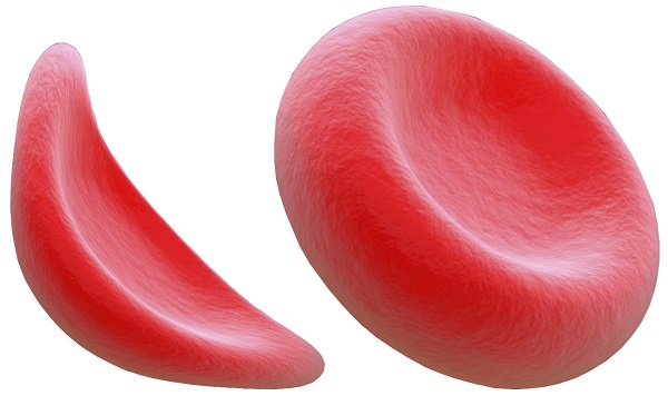 Shine the light on sickle cell