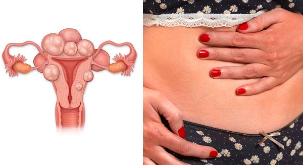 Why do fibroids develop?