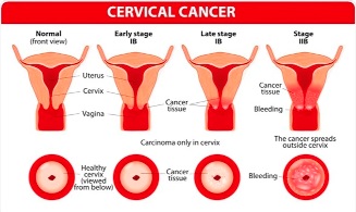 Road to ending HPV cancer epidemic; Awareness, vaccination