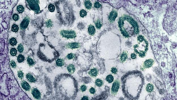 Marburg Virus Disease update: 3 cases, 2 deaths recorded in Ghana