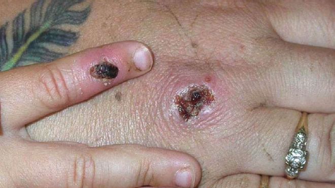 Monkeypox outbreak is primarily spreading through sex - WHO