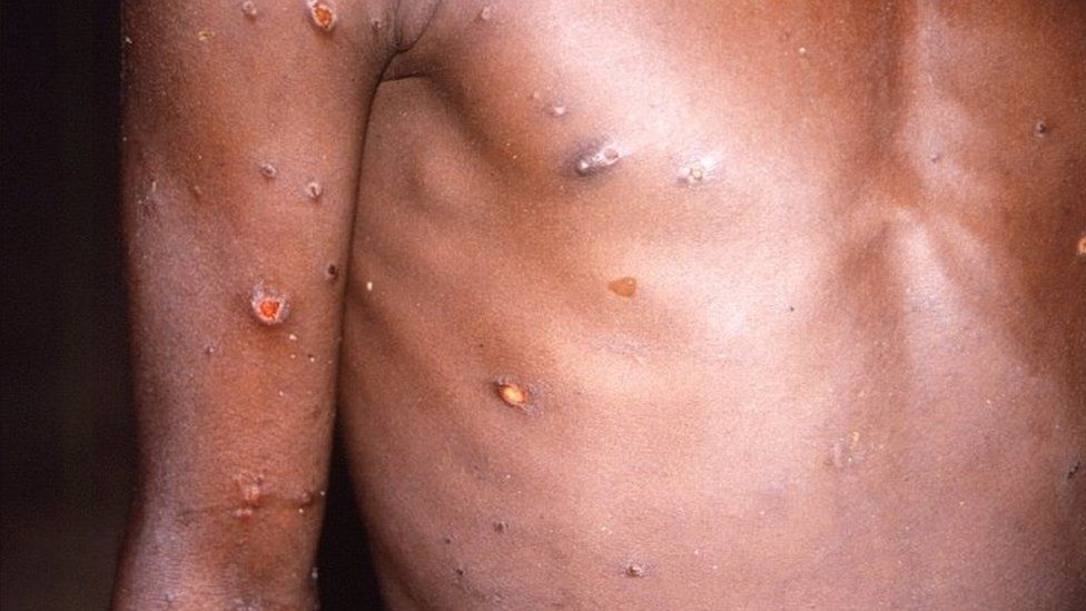 Monkeypox: 80 cases confirmed in 12 countries