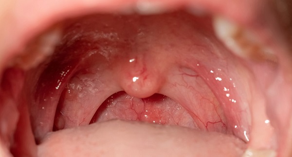 My baby has whitish things on his hard palate