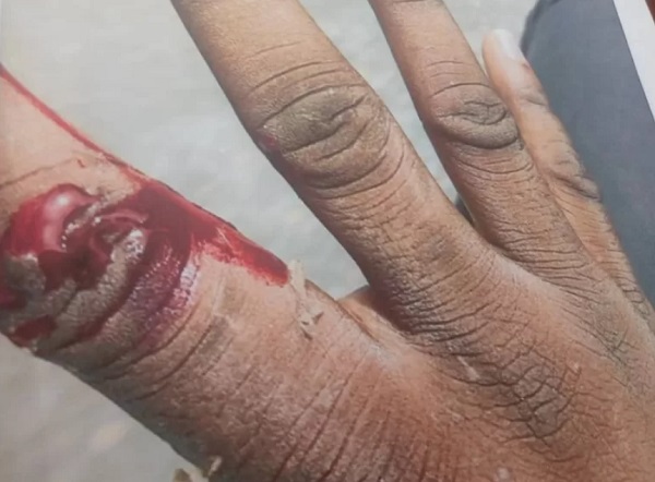 Driver jailed nine months for biting Police Officer’s fingers