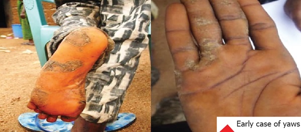 Buruli ulcer, leprosy: Low level awareness increases spread