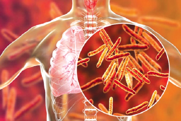 Rich or not Tuberculosis  can affect everyone