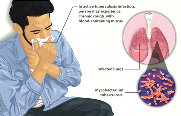 Wiping out Turberculosis - Saving 27m lives by mid-century