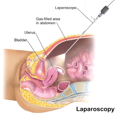 Closing gap: Improving laparoscopy access