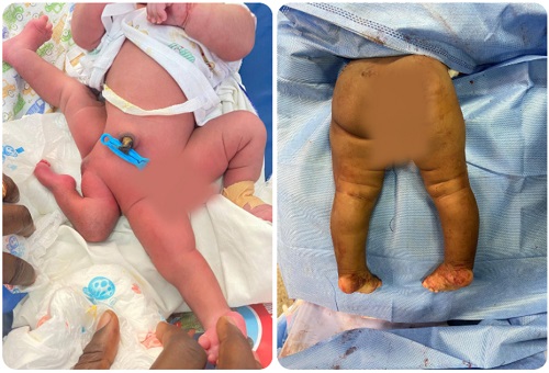 KATH: Medical team successfully performs surgery on infant born with limb malformation