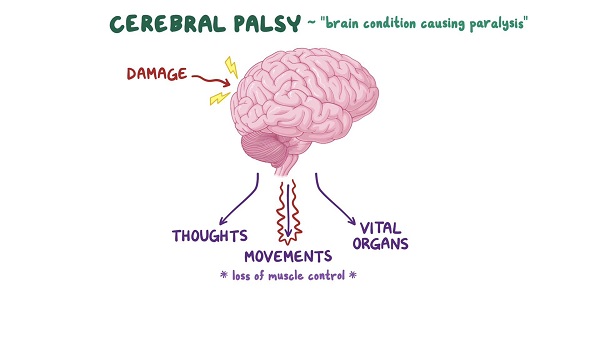 Causes, challenges of Cerebral Palsy