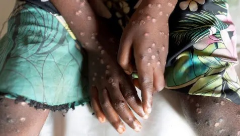 Mpox declared public health emergency in Africa