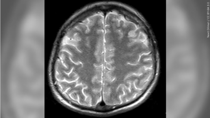 Study shows human brains contain more plastic now than 8 years ago
