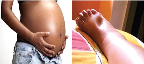 A pregnant woman, A sign of oedema in pregnancy