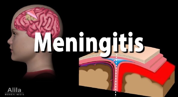 Meningitis season: Let’s be extra careful