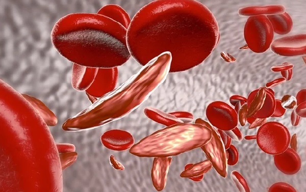 Test for sickle cell, seek expert care - Dr Kwabena Oppong Amoako to public
