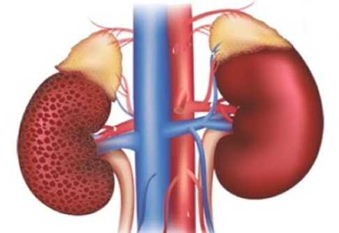 Kidney failure Kidney failures