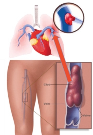 Deep vein thrombosis: A silent killer