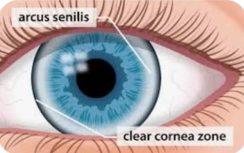  Abrasions in the cornea of my eye