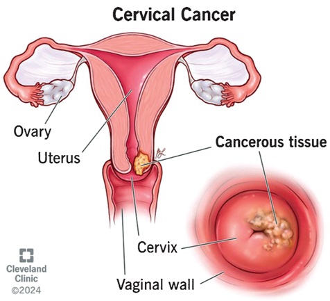 Cancer: Ever-increasing dread in Ghana