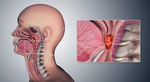 Oral s3x identified as leading cause of throat cancer