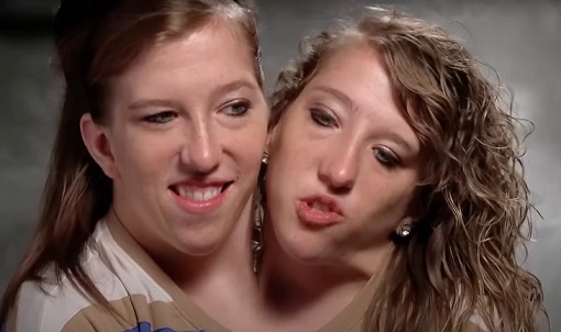 Conjoined twins who paid double college fees now earn one salary, sparking debate