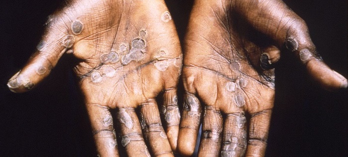 20 new Mpox cases confirmed in Ghana bringing total to 302