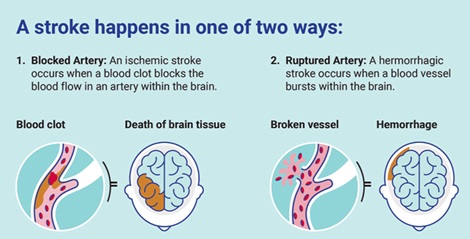 Hemorrhagic Stroke (5) 