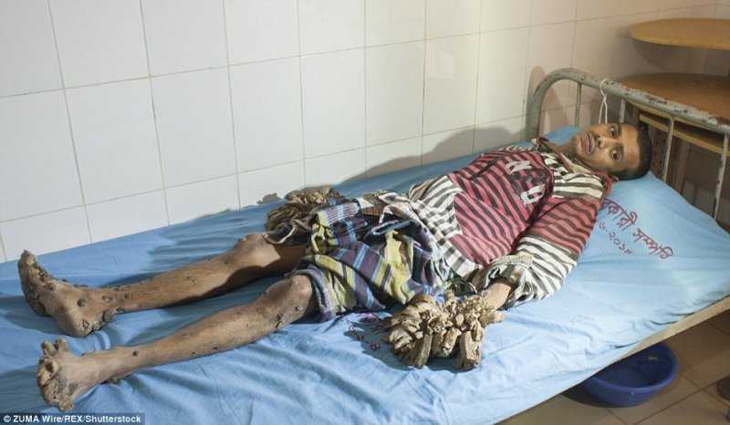 tree2 Tree Man - Getting ready for surgery