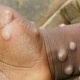 Monkeypox claims 4 lives, 116 local cases recorded