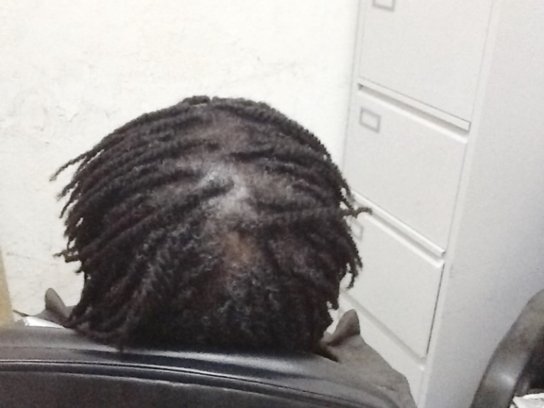 The scalp of the lady whose hair was infected with fungal infection