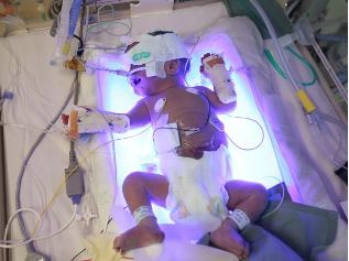 A baby undergoing phototherapy