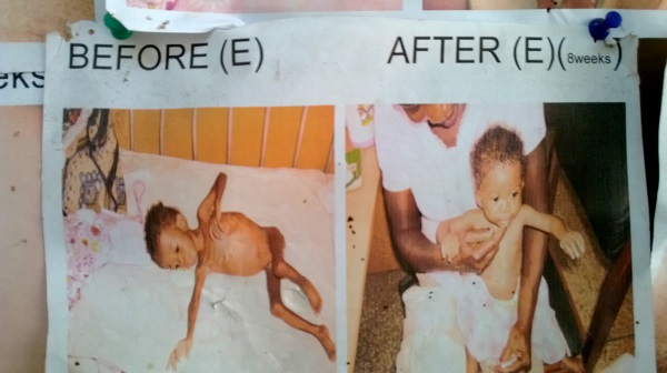 A malnourished child at the Rehabilitation Centre.